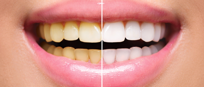 Yellow Teeth: दांत पीला हो गया है तो 2 रुपय की चीज हप्ते में 2-3 बार दांतो पर लगा लें, दोस्त बोलेंगे क्या दांत है?